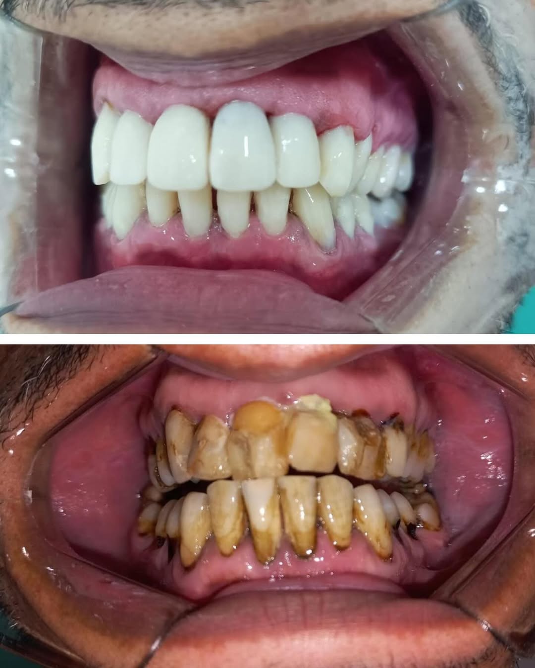 Restauração Estética (antes e depois)